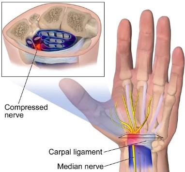 عکس سندروم تونل کارپال